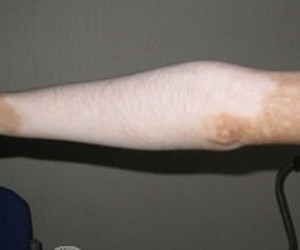 肢端型白癜风发病有什么特征