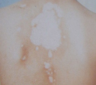 背部的白斑病是啥因素形成的