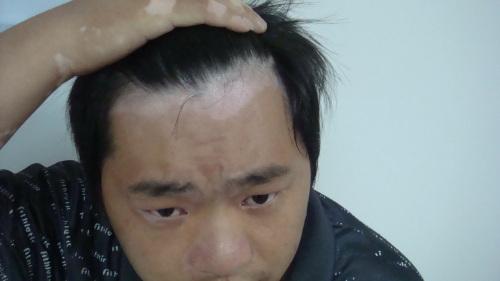 北京治疗白癜风医院：男性白癜风怎样有效护理